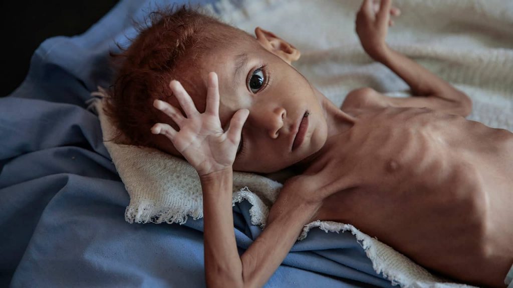 Photo of a starving boy in Yemen